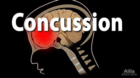 Concussions animation .